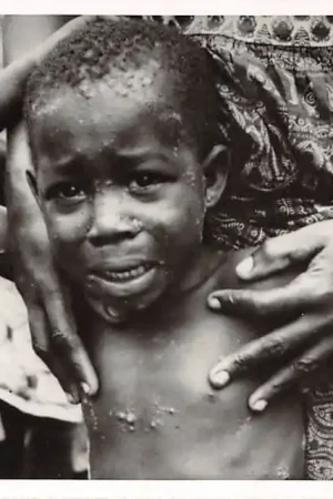 Tani Rotterdam Medische Missie Actie Memisa in Afrika Zwarte kind met framboesia HC39942